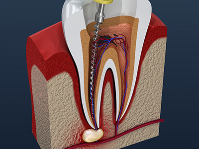 The image displays a 3D rendering of an oral implant procedure, showing a surgical drill and implant fixture inserted into a tooth socket within a realistic human mouth model, with visible bone structure and soft tissue.