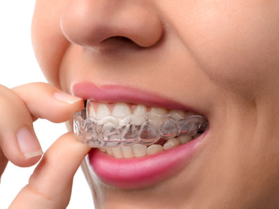 The image shows a person with a clear braces appliance on their teeth, holding a small, white object close to their mouth.