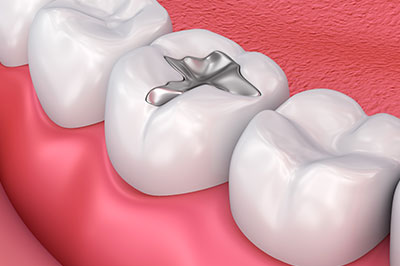 The image shows a close-up view of a dental implant being inserted into a prepared tooth socket within a human mouth, with visible teeth and gum tissue.
