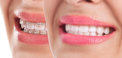 This is a close-up image featuring a person s smiling face with visible teeth and lips. The individual appears to be wearing makeup, specifically lipstick, which is pink and glossy. There are two views of the same face shown side by side, one from the front and one from the side, creating an illusion that the mouth is open in both directions simultaneously.
