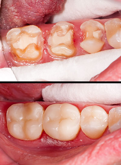 The image shows a close-up view of a person s mouth with a focus on their teeth, which appear to be decayed and in need of dental care, set against a background that alternates between a normal tooth and one with advanced decay.