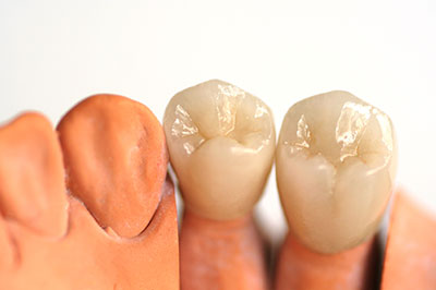The image displays two sets of artificial teeth, one with a visible crown and the other without, set against a white background.