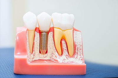 The image shows a model of a human mouth with teeth and gums, featuring a dental implant fixture with a screw visible through the gum line.
