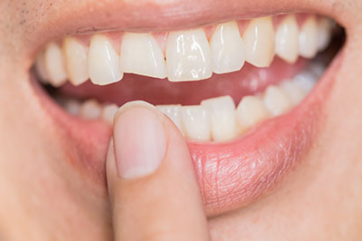 The image shows a person holding their finger near their mouth with a smile, displaying a dental implant on the right side of their upper jaw.