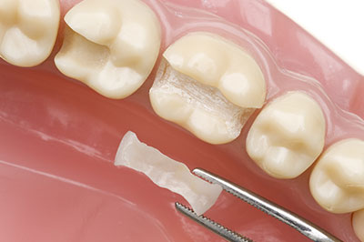 An open mouth dental model with a single tooth missing, featuring a close-up view of a dental implant fixture being inserted into the socket.