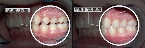 The image shows two photographs side by side  on the left, a close-up of a person s teeth with a label indicating  Malocclusion,  and on the right, the same mouth after dental treatment, labeled as  Normal occlusion.