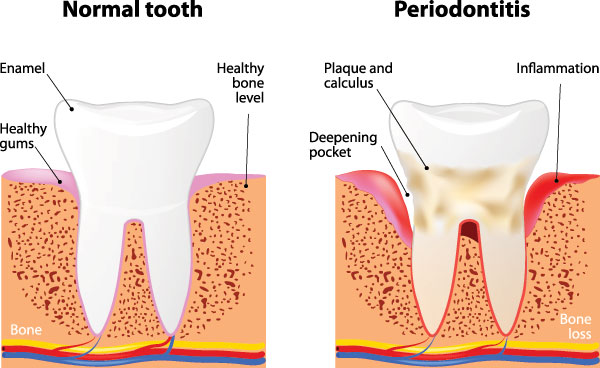 The image depicts four stages of tooth decay progression, with labels indicating normal, healthy bone, periodontitis, and a deepening pocket leading to bone loss.
