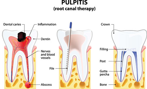 The image is a detailed medical illustration showing a tooth with pulpitis, highlighting inflamed dental pulp, an infected nerve, and surrounding structures such as the root canal, crown, dentin, and jawbone, along with a caption explaining the condition.