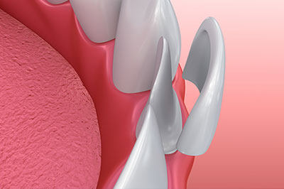 The image displays a medical illustration of a human mouth with a focus on dental implants, showing a close-up view of the artificial teeth and surrounding structures.