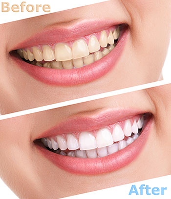 The image shows a person with a wide smile before and after teeth whitening treatment, highlighting the improvement achieved through this cosmetic dental service.