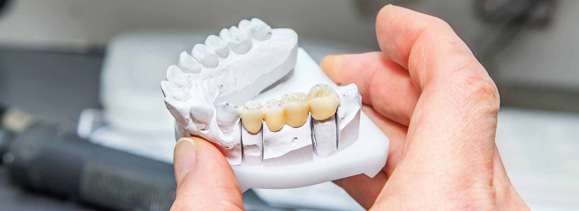 The image shows a person s hand holding a white dental implant with multiple teeth-like structures attached to it, set against a blurred background.