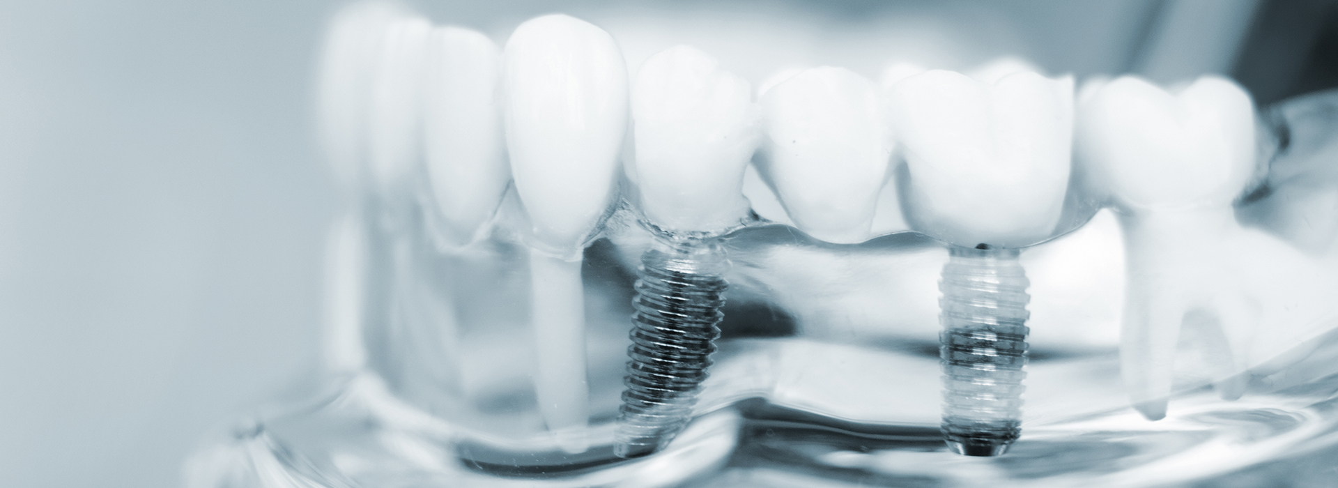 The image shows a close-up view of a dental implant with screws visible, set against a white background.
