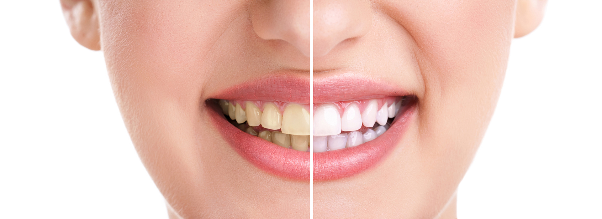The image shows a close-up of a person s face with a focus on their teeth and lips, highlighting a cosmetic dental procedure before and after comparison.