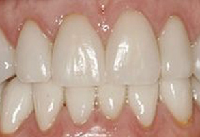 The image shows a close-up view of a person s teeth with a focus on a dental implant, which has a visible screw head extending through the gum line.