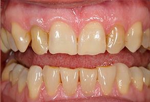 The image shows a close-up view of a person s teeth with visible staining and discoloration, likely due to poor oral hygiene or dental issues.